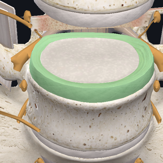 How To Heal A Bulging Disc