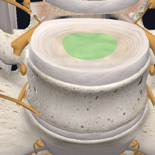 How To Heal A Bulging Disc